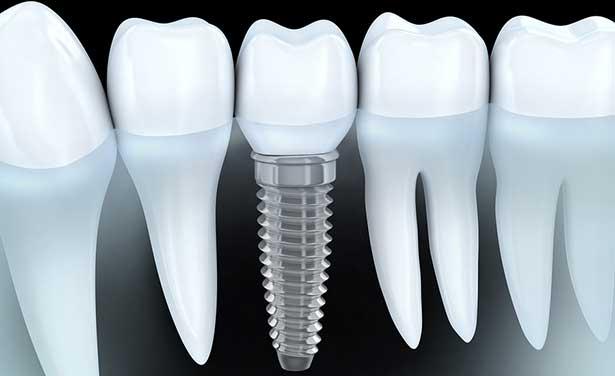 Antidepresanlar diş implant tedavisini olumsuz etkiliyor
