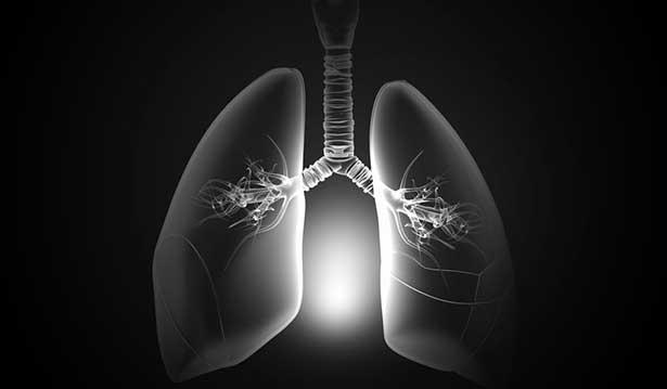Akciğer kanseri kurbanının karısına rekor tazminat