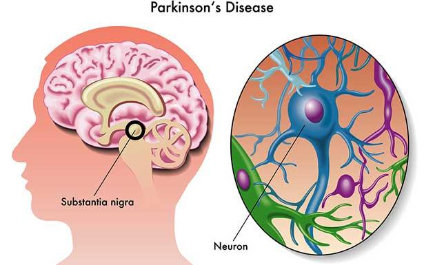 Parkinsona 'elektrotlu çözüm'