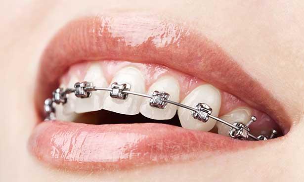 Diş teli tedavisi ile ilgili 5 önemli bilgi