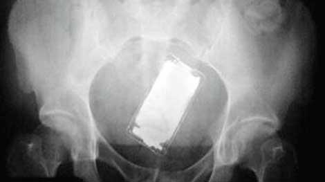 Röntgende iPhone çıktı!