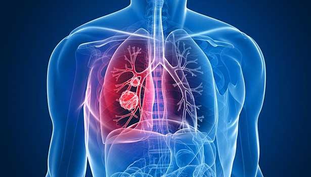 Akciğer kanserinin belirtileri 