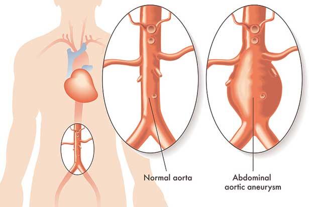Aort yırtılmasında acil müdahale hayat kurtarıyor