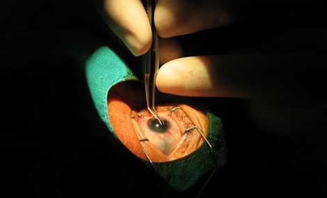 17 katarakt ameliyatı; 6 enfeksiyon, üç körlük
