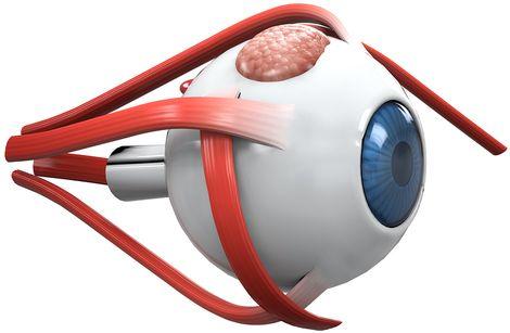 Türk doktorlar yeni bir göz hastalığı keşfetti
