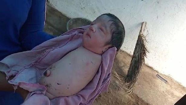 Hindistan’da kolları ve bacakları olmayan bir bebek dünyaya geldi