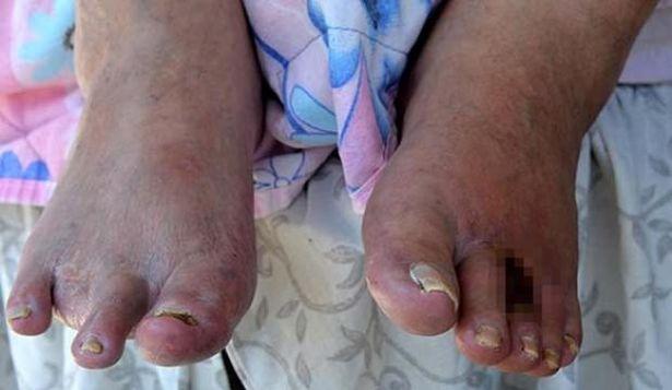 Tromboanjitis obliterans hastası yaşadığı ağrı yüzünden ayaklarımı kesin dedi 
