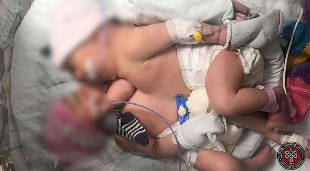 Karın ve göğüsten yapışık ikizler doğumdan 1 hafta sonra 11 saatlik operasyonla ayrıldı 