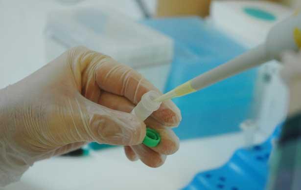 HIV'li hastaya kök hücre tedavisi: Mide lenfomasından kurtuldu