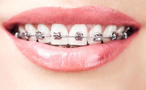 Diş Teli Tedavisinde Temizlik