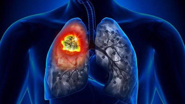 Dünyada 2,2 milyondan fazla yeni akciğer kanseri teşhisi kondu