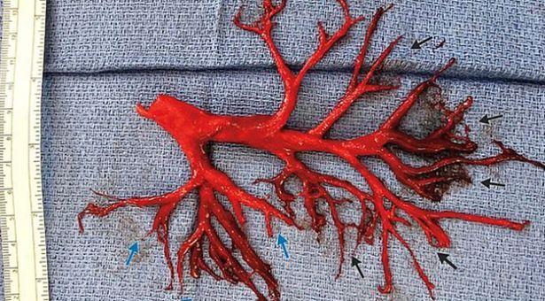 Ender vaka: Öksürünce bronş ağacı çıkan hasta hayatını kaybetti 