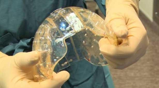 Tıp tarihinde bir ilk: Plastik kafatası nakli
