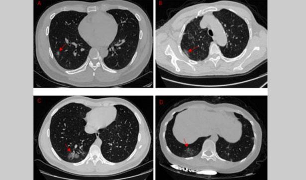 Covid-19 hastalarında, iyileştikten aylar sonra bile kalıcı akciğer hasarı meydana gelebilir