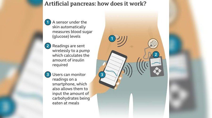 İngiltere: Diyabet hastalarına yapay pankreas teknolojisi sunulacak