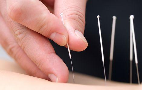  Akupunktur acil servislerde kullanılabilir 