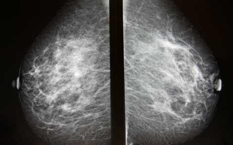 Mamografi gereksiz tedavi mi yaptırıyor?
