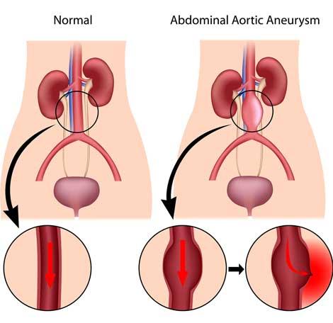 Cerrahların sevmediği sürpriz: "Abdominal aort anevrizması"