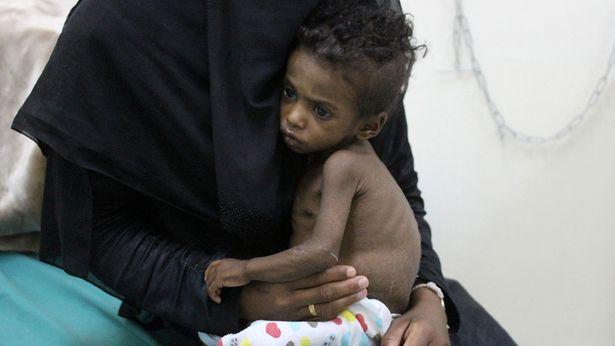 Dünya Sağlık Örgütü: Yemen'de 7 milyon 400 bin çocuk yetersiz besleniyor