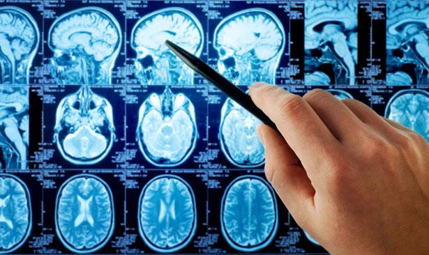 Arginin tedavisi, beyin metastazı olan kanser hastalarında radyasyon tedavisinin etkinliğini artırıyor