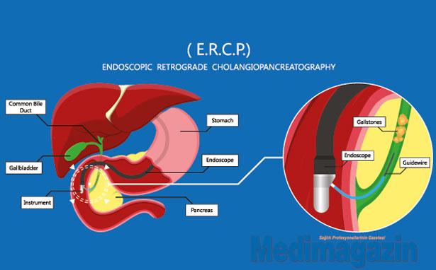 ERCP işlemlerini kimler yapmalı? Türk Gastroenteroloji Derneği'nden cevap geldi!