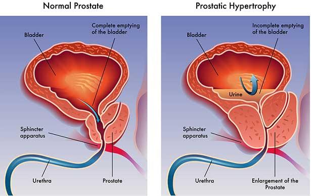 Prostat kanseri riski yüksek erkekler, bir 'tükrük testi' ile belirlenebilir
