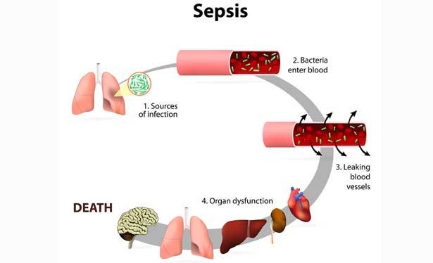 Enfeksiyon kaynaklı ölümlerin yüzde 60'ından sepsis sorumlu